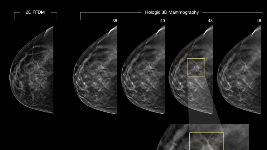 PHOTO GALLERY What does breast cancer look like on mammography